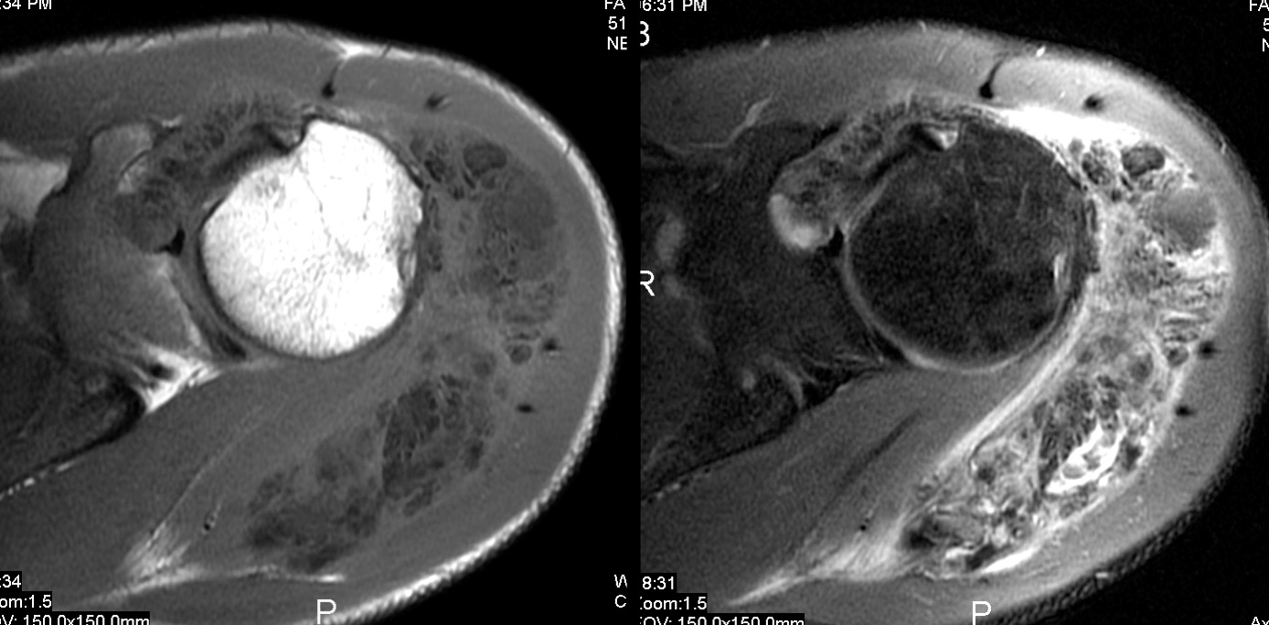 Figure 5 for case tumoral calcinosis ( RID5202 )